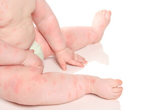 cuerpo-de-bebé-con-alergia Tipos de alergias en bebés