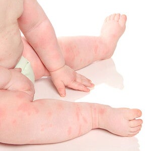 cuerpo-de-bebé-con-alergia Tipos de alergias en bebés